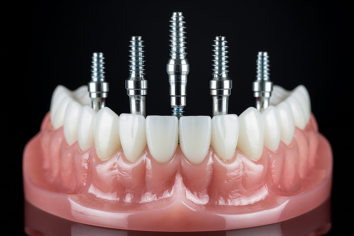 post_25_1 Cosmodent Candelaria - Clínica Dental en Tenerife | Implantes Dentales: ¿Cómo Funcionan y Cuándo Son Necesarios?