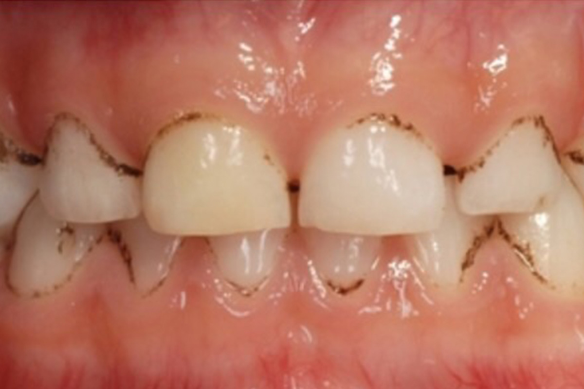 27_1 Cosmodent Candelaria - Clínica Dental en Tenerife | Manchas cromógenas en los dientes: causas, tratamientos y prevención