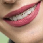 27_2 Cosmodent Candelaria - Clínica Dental en Tenerife | Ortodoncia invisible: cómo funciona y cuáles son sus beneficios