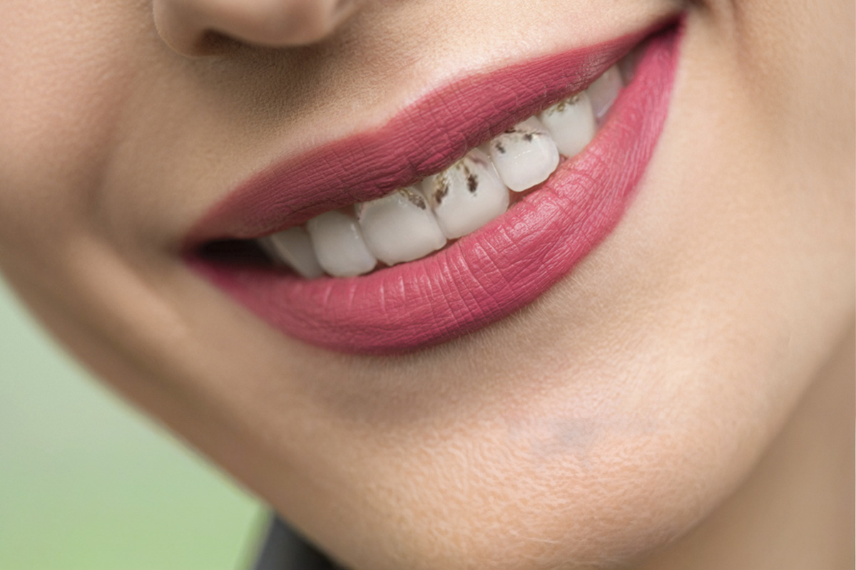 27_2 Cosmodent Candelaria - Clínica Dental en Tenerife | Manchas cromógenas en los dientes: causas, tratamientos y prevención