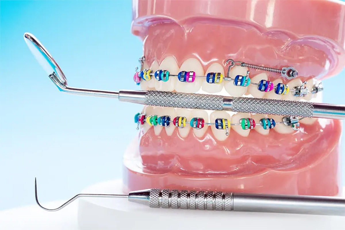 post28_1 Cosmodent Candelaria - Clínica Dental en Tenerife | Nuevo método en ortodoncia: Microtornillos