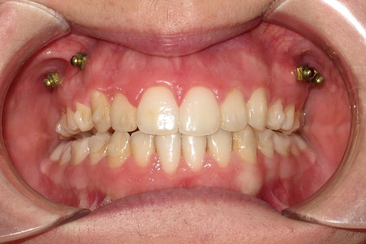 post28_3 Cosmodent Candelaria - Clínica Dental en Tenerife | Nuevo método en ortodoncia: Microtornillos