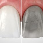 Cosmodent Candelaria - Clínica Dental en Tenerife | Ortodoncia interceptiva vs correctiva: diferencias clave